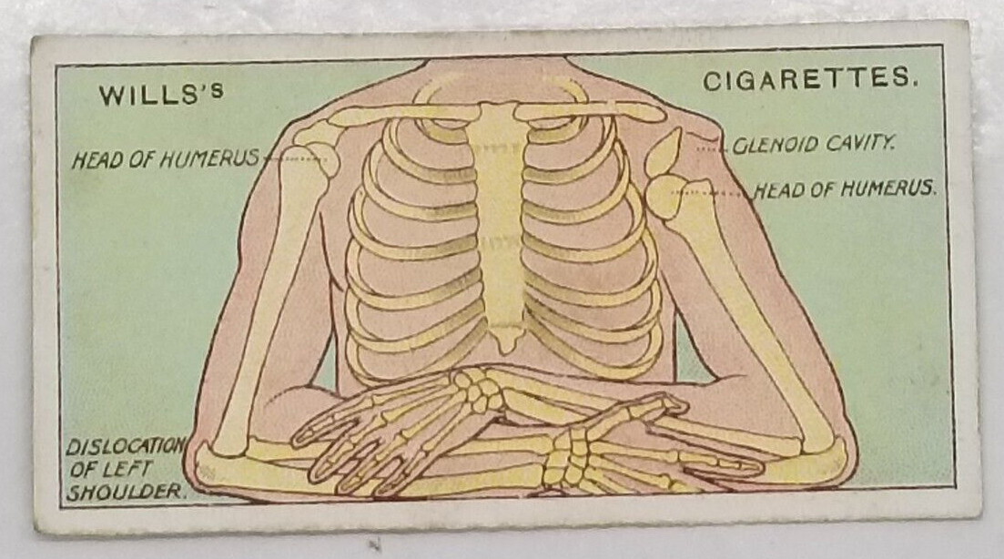 Wills’s First Aid DISLOCATED SHOULDER Vintage Medical Cigarette Card #45